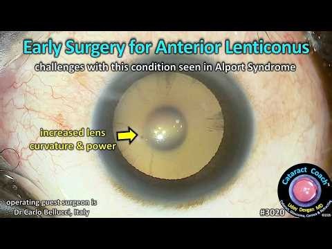 CataractCoach™ 3020: early surgery for anterior lenticonus in Alport Syndrome