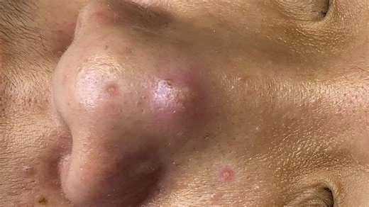 Severe acne treatment with pimple popping of Loan Nguyen - The Best Pimple Popping 2023 Videos You ll Find on the Internet