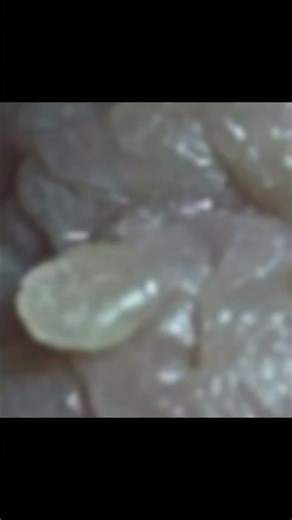 Κονδυλώματα HPV σε Γυναίκες και Άνδρες