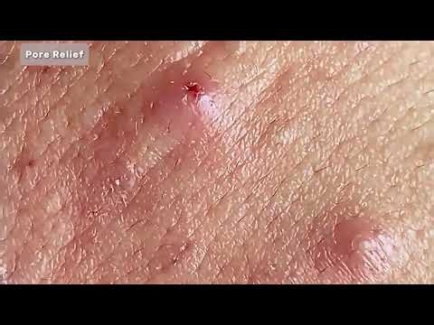 Extreme Blackhead Removal 😱 | Satisfying Pimple Popping & Deep Acne Extraction