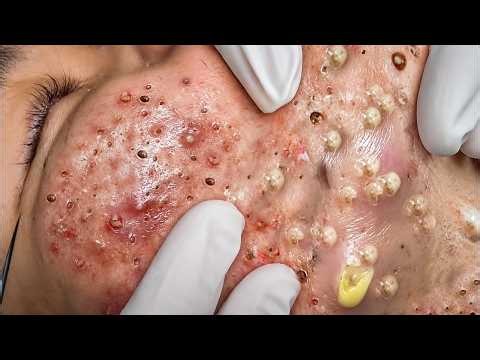 LIVE Blackhead Removal ASMR 🔴