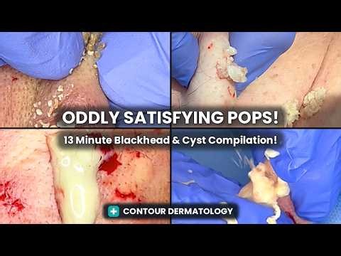 13 Minutes of Cysts & Blackheads Extraction! 😮 | Satisfying Pops Compilation | CONTOUR DERMATOLOGY
