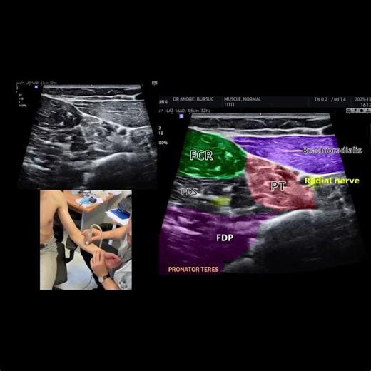 Pronator teres spasticity – Rond pronateur spasticité Short