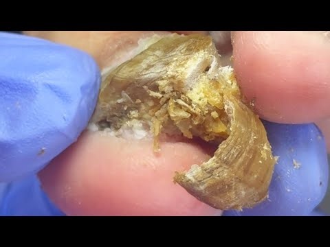 How To Remove Super Thick Onychomycosis Step By Step【Podiatry Clinic】
