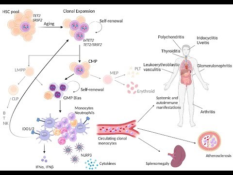 Pathogenesis of childhood Leukemia; genetic mutations, second hits