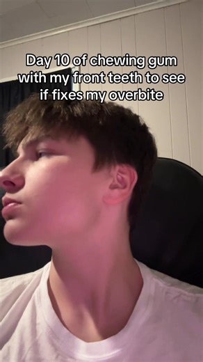Day 10 #overbite #jawline | Chewing Gum