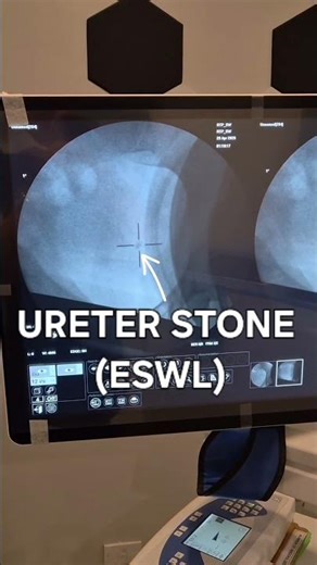 (ESWL)- 32 year old female Patient with 0.8cm left Ureter stone