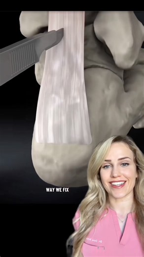 Doctor explains Achilles surgery