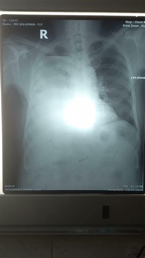 Right sided encysted pleural effusion