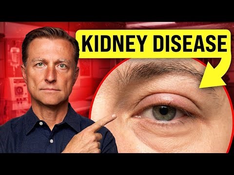 18 Visible Signs of Kidney Disease You Shouldn’t Ignore