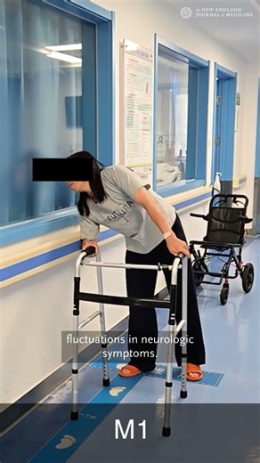 Clinical Assessment of Ambulation in Patient 5 after JY231 Infusion