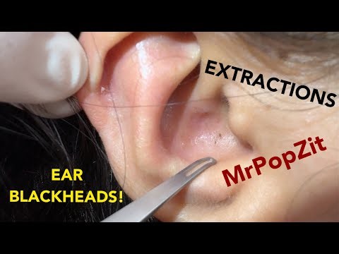 Very close up ear blackhead extractions. Front row seat to loop extractor technique for ear pops!