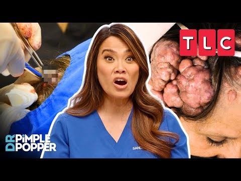 Every. Single. Pop. EVER! | Dr. Pimple Popper | TLC