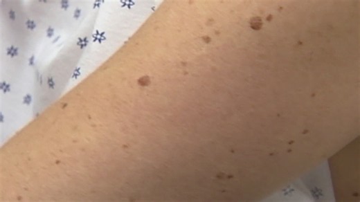 Iowa doctor shares skin cancer awareness tips as summer approaches