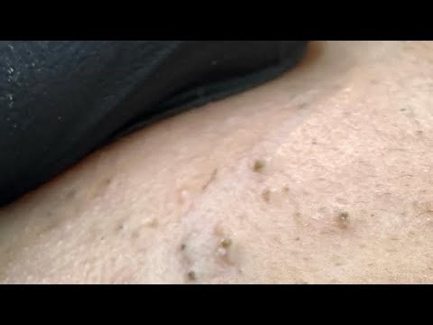Blackhead And Whitehead Removal - Extreme Pimple Extraction