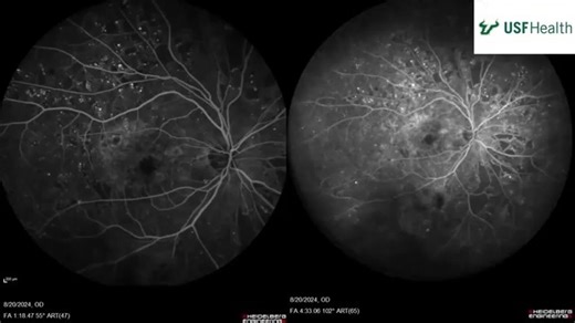 NPDR with capillary non-perfusion - 非增殖期糖尿病视网膜病变伴视网膜毛细血管无灌注区