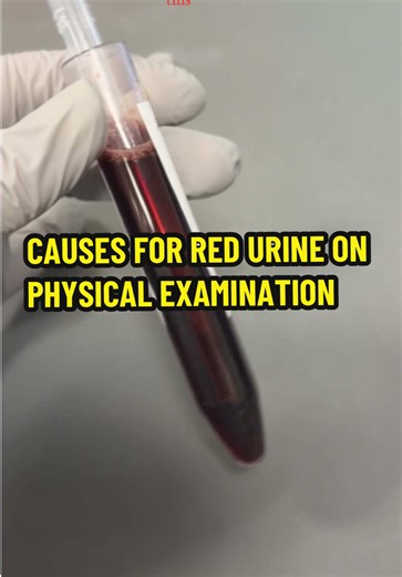 Potential causes for red urine on physical examination #urinalysis #lab #medtechtok #cls #science