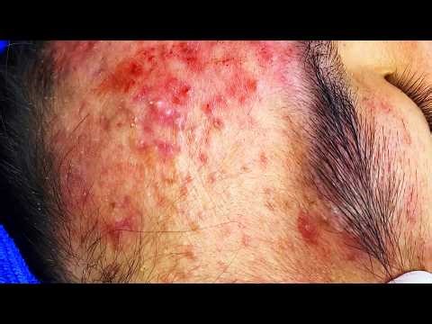 Acne Treatment Transformation 😱 | Real Skin Healing Journey