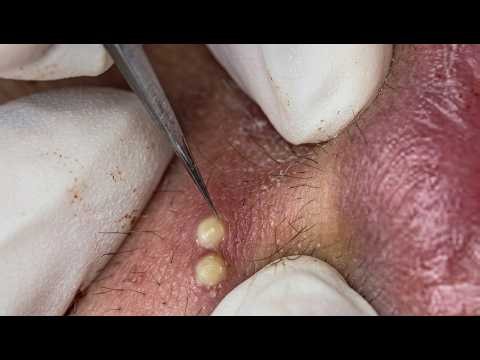 NEW 2026 - RELAXING FULL FACIAL BLACKHEAD EXTRACTION SESSION#10391