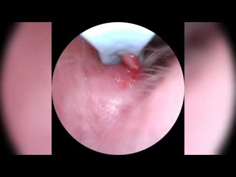 Pimple Popping - Ultimate Pimple Popping Compilation#119