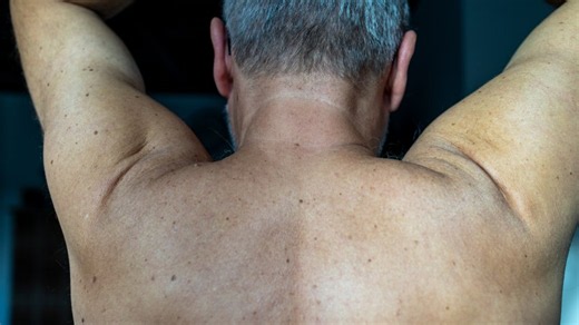Moderna and Merck say mRNA vaccine shows promise for treating melanoma
