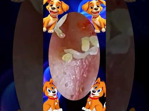 Blackheads Removal | Acne Treatment and Very Satisfying Satisfying Pimple pop #blackheads