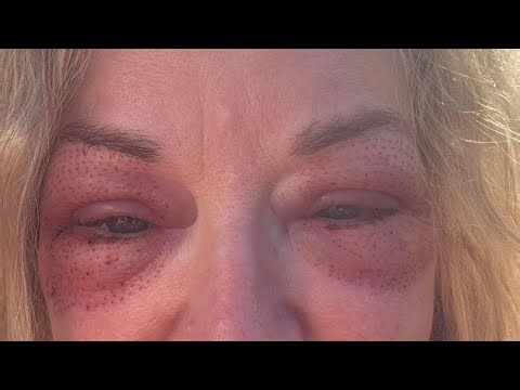 Plasma Eye Lift – 1 Month On | What It Really Looks Like