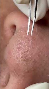 So Satisfying Pimples Removal & Popping I Skin Care Short 104