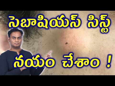 సెబాషియస్ సిస్ట్ చికిత్స | Sebaceous Cyst Permanant Treatment | Skin Cyst Cure Medicine Arogyam Max