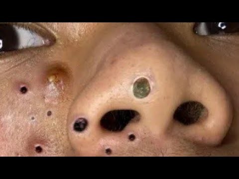 Deep blackhead Removal 2025, acne removal spa, big pimple 2025, #acne #pimple #cyst