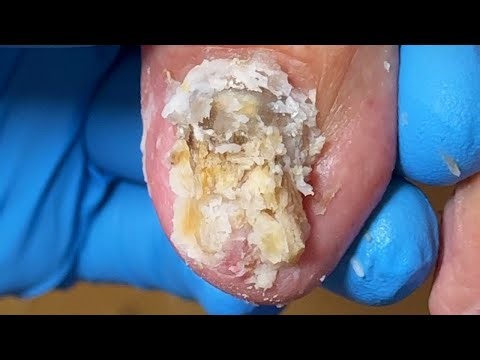 The Patient's Two Toenails Were Severe And A Thorough Pedicure Was Required【Xue Yidao】