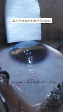 Live Contoura LASIK Surgery