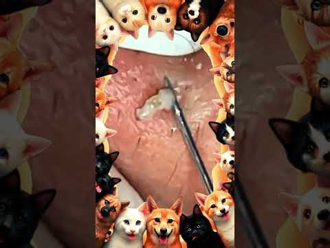 Blackheads Removal | Acne Treatment and Very Satisfying Satisfying Pimple pop #blackheads