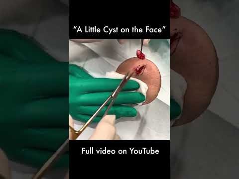 A Little Cyst on the Face