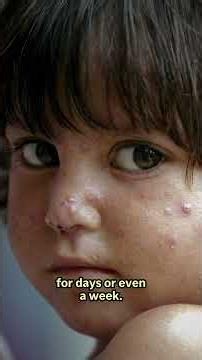 Why Scratching A Bug Bite Feels Good But Is Actually A Bad Idea, Science Explains | N18S