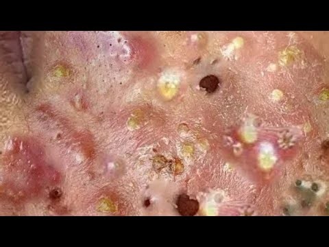 Deep blackhead Removal 2026, acne removal spa, big pimple 2026, #acne #pimple #cyst