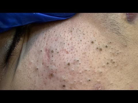 Extreme Deep Pore Cleaning – Shocking Blackhead Removal