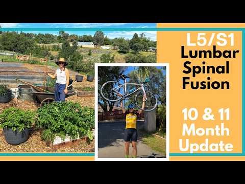 Fusion Surgery Update - 10 & 11 Months Post-op