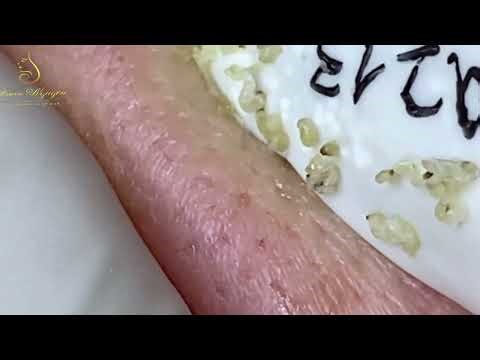 Loan Nguyen Acne Treatment 30qq