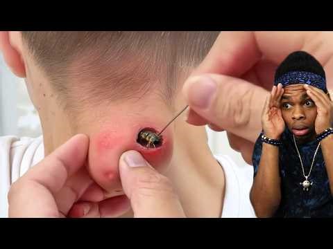 he shouldn't have popped it..