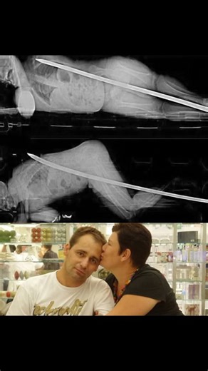 Macabre Knowledge on Instagram: "January 2015, nearly 3.5 kilometers underground in a South African mine, engineering supervisor Daniel De Wet was doing routine maintenance work. No drama. No rush. No warning. He was clearing hardened mud from a dam wall using a long steel crowbar when he slipped in the confined, poorly lit space. The fall lasted seconds. The consequences should have been final. 🩻 The Injury That Defied Anatomy Daniel landed directly onto the metal rod. The bar entered through 