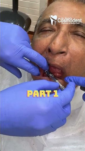 Part 1 Painless 6 Dental Implants Procedure Keyhole Surgery Lower Jaw Restoration in Mira Road