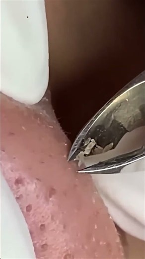 Ultimate Acne Extraction | Relaxing Blackhead Removal & Skincare Treatment #007