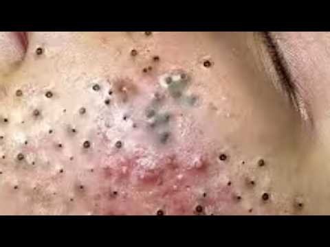 Deep blackhead Removal 2026, acne removal spa, big pimple 2026, #acne #pimple #cyst