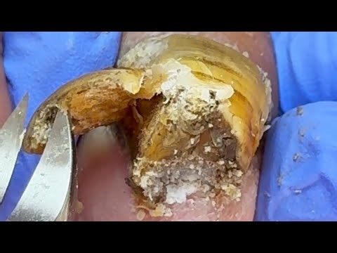 Amazing Toenails Thickness! Remove Bad Nails Step By Step!【Xue Yidao】