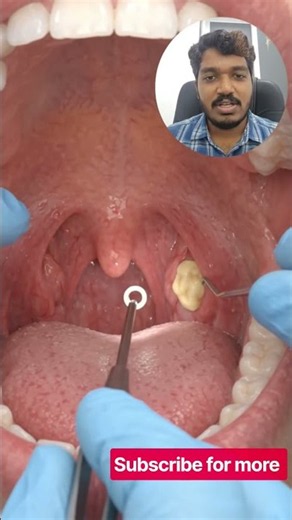 Tonsil Stone Removal #tonsilstones #tonsilstoneremoval #oralhealth #badbreathremedy