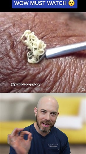 Extraction Physics: Why Tool Size Matters for Large Cysts