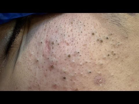 Deep Cleansing Techniques for Acne & Blackheads | Morning Facial Routine