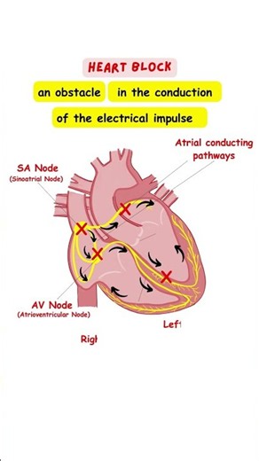 HEART BLOCKS | CARDIOLOGY | ECG #medicalstudents #ecg #cardiology