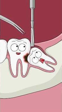 How They Pulled Out His Wisdom Tooth